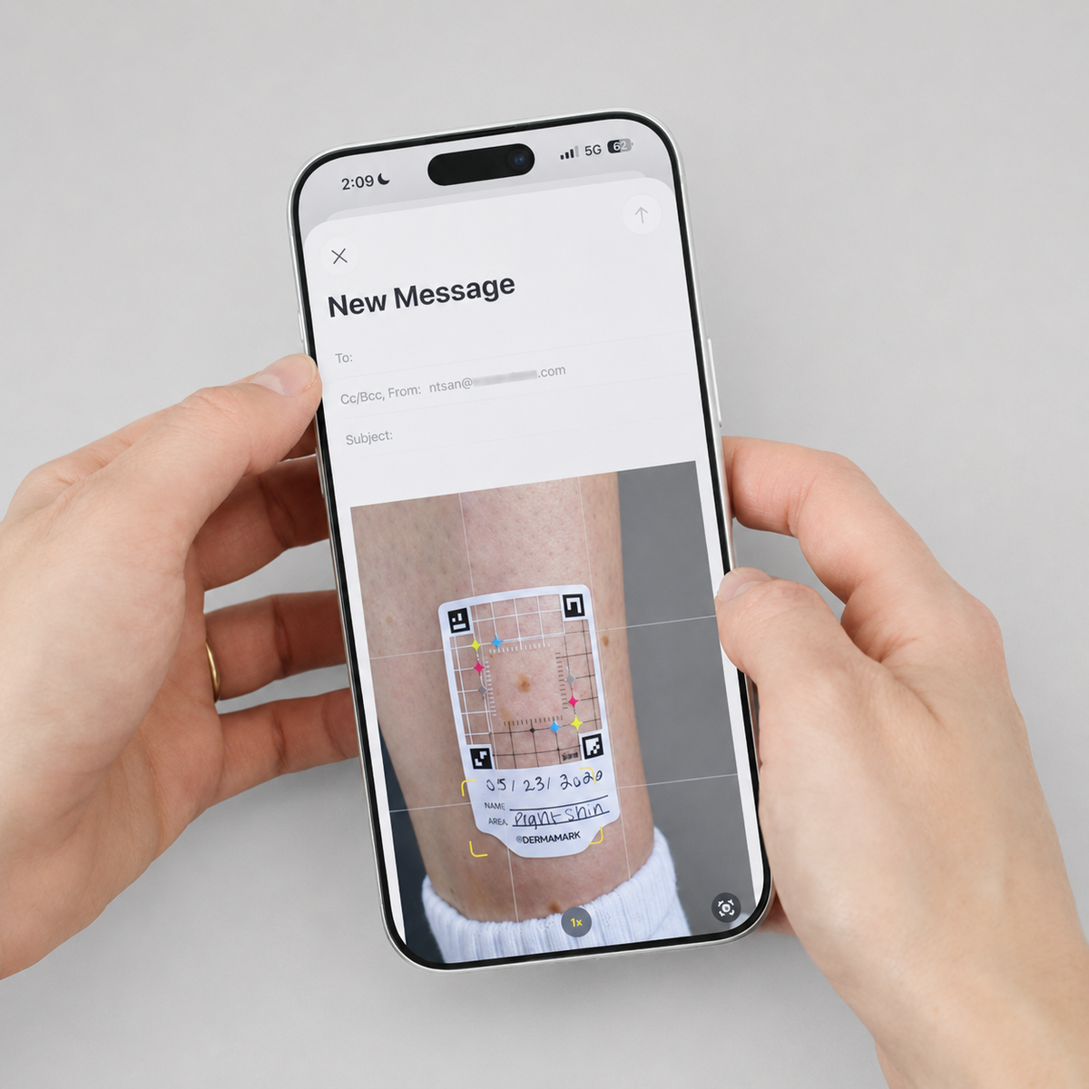 Skin tracking sticker on arm, photographed via smartphone for mole monitoring and dermatology documentation