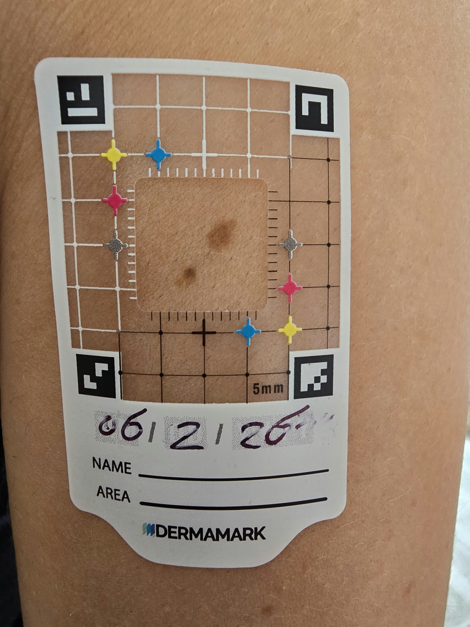 
                      With Dermamark | 6 Months Later
                    