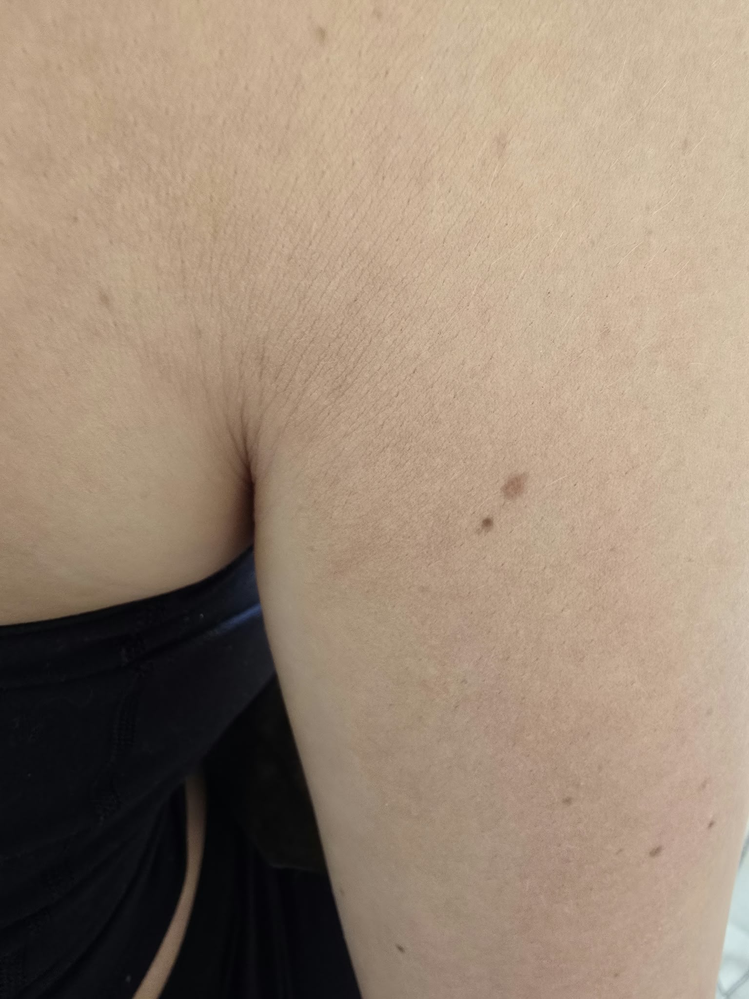 
                      Without Dermamark | 6 Months Later
                    
