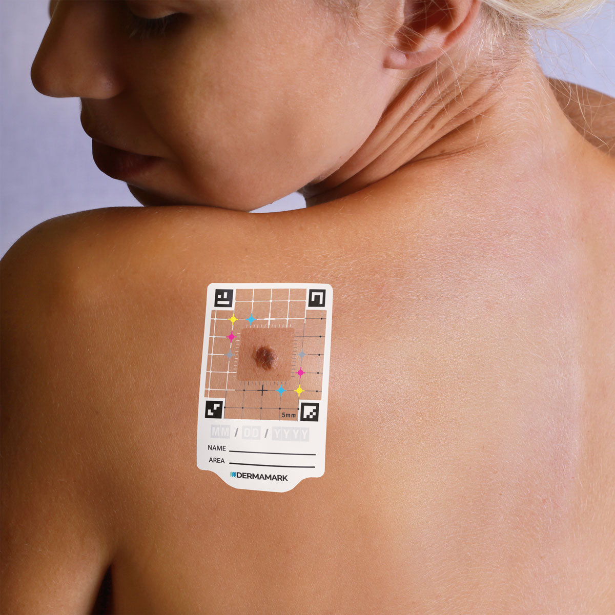 Skin tracking sticker on shoulder monitoring mole with grid and color markers for dermatology